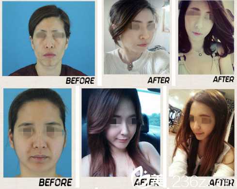 童颜整形前后对比图 童颜整形前后对比图