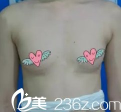 术前胸部平坦 术前胸部平坦