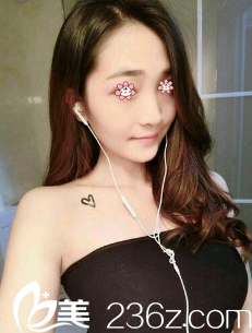 杨东运自体脂肪隆胸术后20天