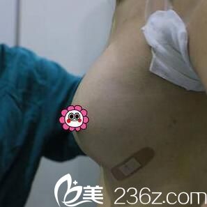 做假体隆胸术后即可效果