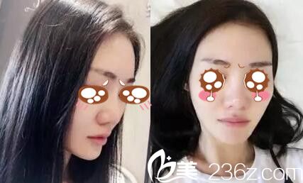 驻马店金玄宫隆鼻顾客术前照 驻马店金玄宫隆鼻顾客术前照