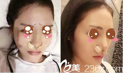 驻马店金玄宫隆鼻手术即刻照 驻马店金玄宫隆鼻手术即刻照