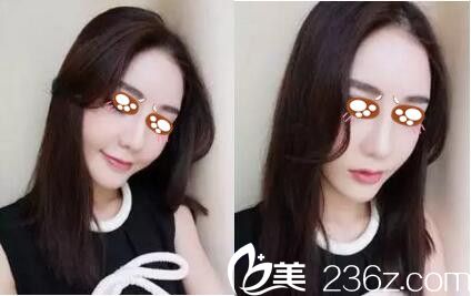 驻马店金玄宫做隆鼻手术20天 驻马店金玄宫做隆鼻手术20天