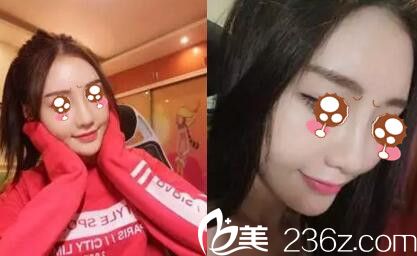 驻马店金玄宫做隆鼻手术1个月 驻马店金玄宫做隆鼻手术1个月