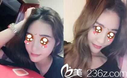 有幸在驻马店金玄宫整形找张怀军院长做了假体隆鼻 3个月鼻子就恢复自然不惧揉捏