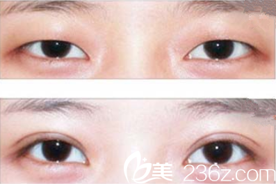 岳阳你美眼部整形效果