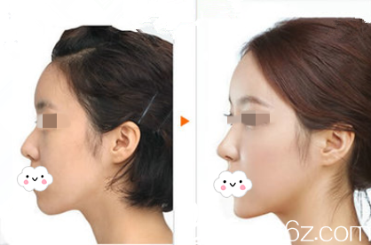 岳阳你美鼻部整形真人案例