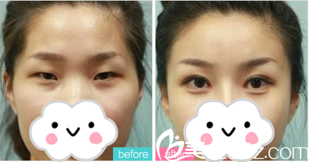 游鹏飞院长双眼皮真人案例