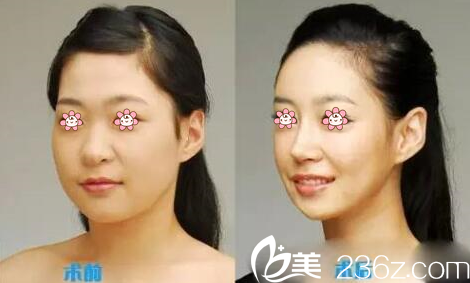 任在浩院长去颊脂垫案例 任在浩院长去颊脂垫案例