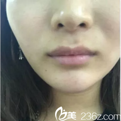 在北京美莱注射丰唇前样子 在北京美莱注射丰唇前样子