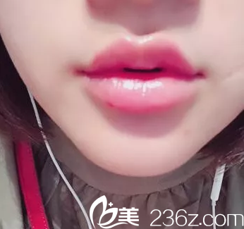 在北京美莱玻尿酸注射丰嘟嘟唇第8天效果 在北京美莱玻尿酸注射丰嘟嘟唇第8天效果