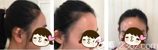 韩国Bozar毛发移植中心裴强益发际线种植真人案例术前照 韩国Bozar毛发移植中心裴强益发际线种植真人案例术前照