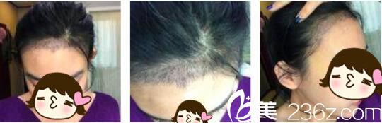 韩国Bozar毛发移植中心裴强益发际线种植真人案例术后第七天 韩国Bozar毛发移植中心裴强益发际线种植真人案例术后第七天