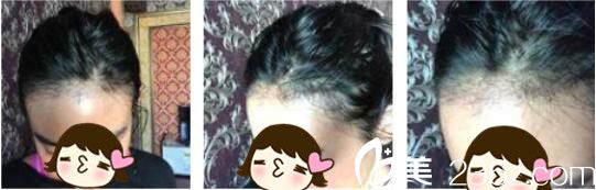 韩国Bozar毛发移植中心裴强益发际线种植真人案例术后一个月 韩国Bozar毛发移植中心裴强益发际线种植真人案例术后一个月