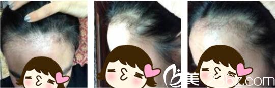 韩国Bozar毛发移植中心裴强益发际线种植真人案例术后三个月 韩国Bozar毛发移植中心裴强益发际线种植真人案例术后三个月