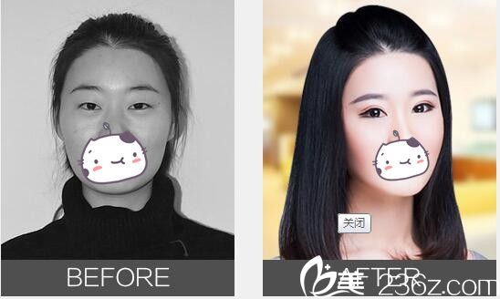 本来想找无锡尚美陶波院长改善眯眯眼但看了无锡丽都陈光平院长双眼皮