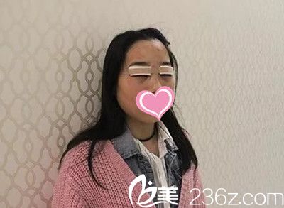 双眼皮手术后1天