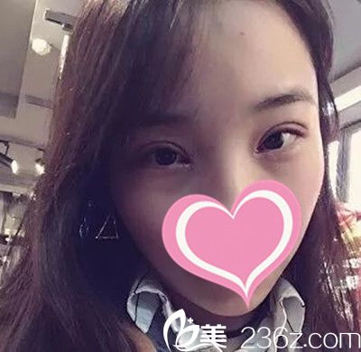 双眼皮 拆线了
