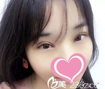 许言午双眼皮手术案例