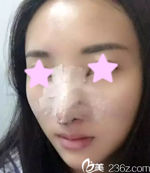 我在大同清木做自体肋骨隆鼻后第5天照片