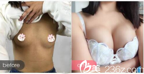 广州曙光张元龙做的假体隆胸案例
