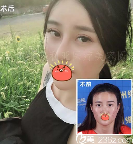 杭州维多利亚周长兵双眼皮和隆鼻案例 杭州维多利亚周长兵双眼皮和隆鼻案例