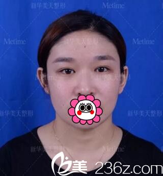 做眼鼻综合手术术前照 做眼鼻综合手术术前照