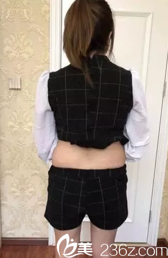 我在大同清木整形做腰腹部吸脂前照片 我在大同清木整形做腰腹部吸脂前照片