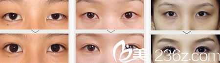 双眼皮整形案例 双眼皮整形案例