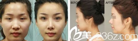 隆鼻整形案例 隆鼻整形案例