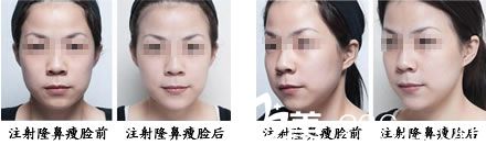 注射瘦脸整形案例 注射瘦脸整形案例