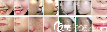 激光祛痘祛斑整形案例 激光祛痘祛斑整形案例