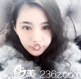 任在浩双眼皮加开眼角术后半个月 任在浩双眼皮加开眼角术后半个月