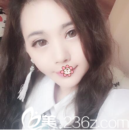 韩国i-Line整形外科双眼皮术后39天 韩国i-Line整形外科双眼皮术后39天