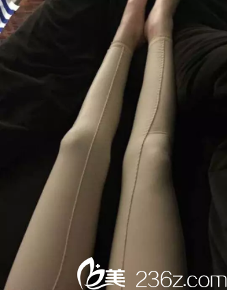 在北京壹加壹找王珂做腿部吸脂第13天效果 在北京壹加壹找王珂做腿部吸脂第13天效果