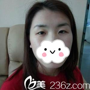 单眼皮的我 单眼皮的我