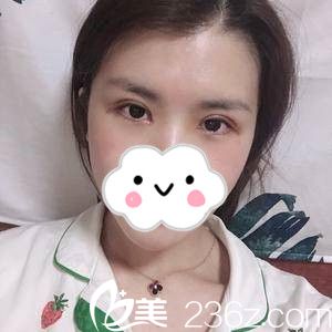 双眼皮手术后半个月 双眼皮手术后半个月