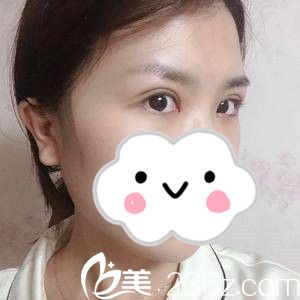 双眼皮手术第22天 双眼皮手术第22天