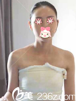 宁夏华美整形自体脂肪隆胸第6天 宁夏华美整形自体脂肪隆胸第6天