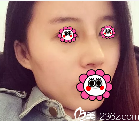 在北京米扬丽格做鼻修复第9天效果