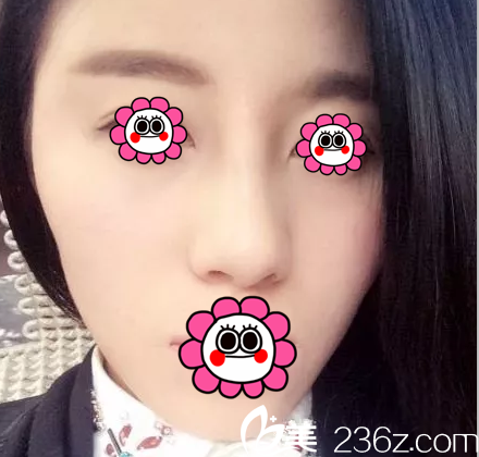 在北京米扬丽格找巫文云做鼻修复第16天效果