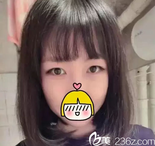 在北京米兰柏羽丽都做双眼皮前样子 在北京米兰柏羽丽都做双眼皮前样子