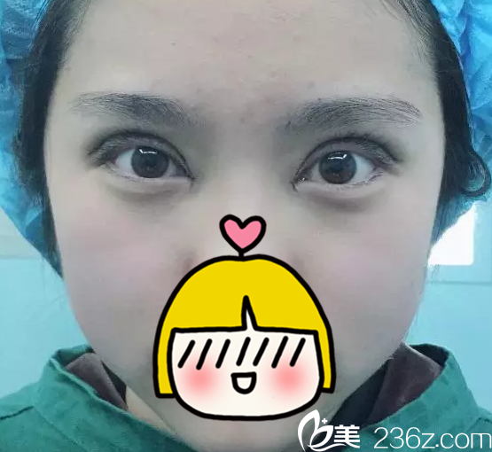 北京米兰柏羽丽都做双眼皮术后即刻样子 北京米兰柏羽丽都做双眼皮术后即刻样子