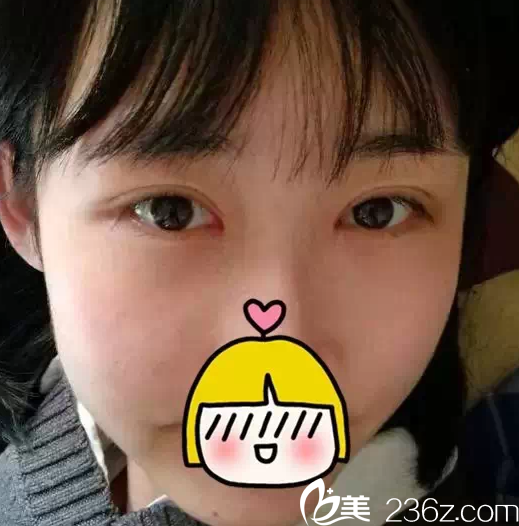 北京米兰柏羽丽都于晓春给我做双眼皮开眼角一个月效果 北京米兰柏羽丽都于晓春给我做双眼皮开眼角一个月效果