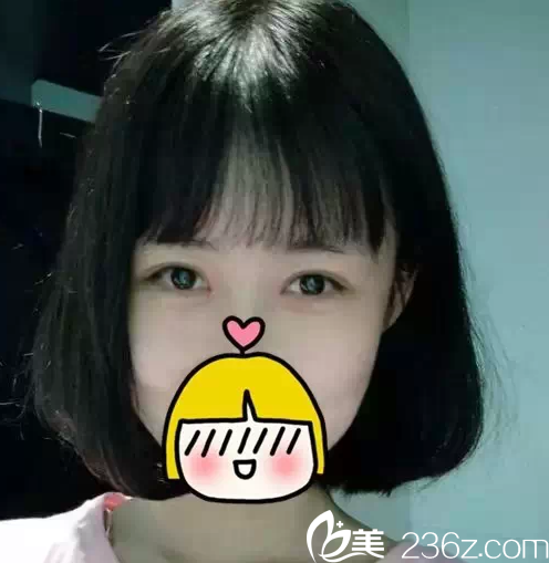 北京米兰柏羽丽都切开双眼皮案例 北京米兰柏羽丽都切开双眼皮案例