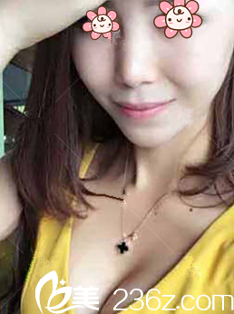 何林自体脂肪隆胸术后19天 何林自体脂肪隆胸术后19天