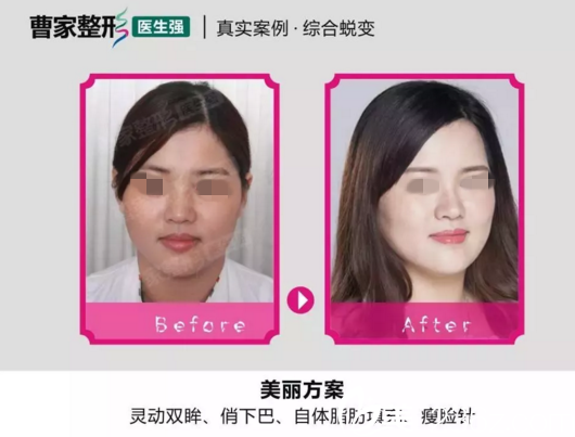 衡阳曹家自体脂肪整形真人案例