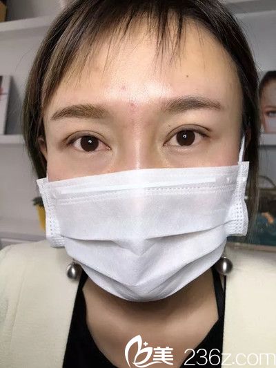 青海米澜之星双眼皮手术案例