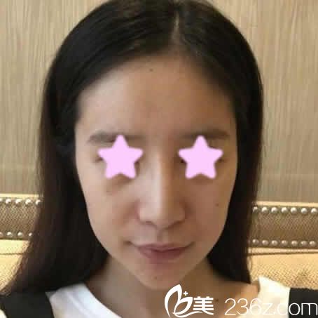 我在太原欧美莲整形美容医院做全脸自体脂肪填充前照片 我在太原欧美莲整形美容医院做全脸自体脂肪填充前照片