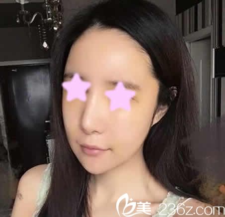 我在太原欧美莲做面部自体脂肪填充术后第3天照片 我在太原欧美莲做面部自体脂肪填充术后第3天照片